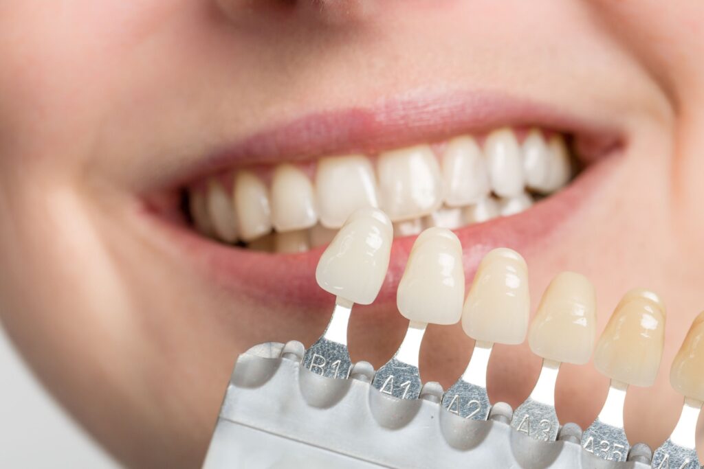 Closeup of someone smiling with shade guide held up to their teeth